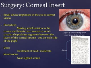 • Small device implanted in the eye to correct
vision
• Procedure:
Making small incision in the
cornea and inserts two crescent or semi-
circular shaped ring segments between the
layers of the corneal stroma , one on each side
of the pupil
• Uses:
Treatment of mild– moderate
keratoconus
Near sighted vision
Surgery: Corneal Insert
A pair of corneal rings after
insertion into the cornea
Stroma
 