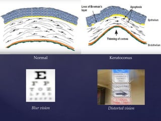 KeratoconusNormal
Blur vision Distorted vision
 