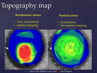 Keratoconus cornea
• Non symmetrical
• Inferior Steeping
Normal cornea
• Symmetrical
• No excessive steeping
Topography map
Blue shows the flattest areas, and red the steepest
 