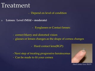 o Depend on level of condition
1) Lenses: Level (Mild – moderate)
• Eyeglasses or Contact lenses:
- correct blurry and distorted vision
- glasses or lenses changes as the shape of cornea changes
• Hard contact lens(RGP):
- Next step of treating progressive keratoconus
- Can be made to fit your cornea
Treatment
Hard contact lens (RGP)
 