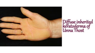 Diffuse inherited
keratoderma of
Unna Thost
 