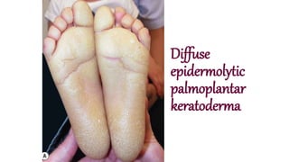 Diffuse
epidermolytic
palmoplantar
keratoderma
 