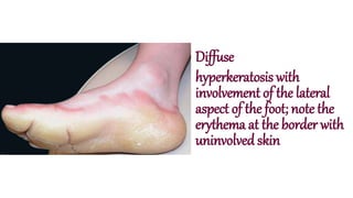 Diffuse
hyperkeratosis with
involvement of the lateral
aspect of the foot; note the
erythema at the border with
uninvolved skin
 