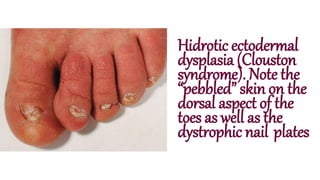 Hidrotic ectodermal
dysplasia (Clouston
syndrome). Note the
“pebbled” skin on the
dorsal aspect of the
toes as well as the
dystrophic nail plates
 