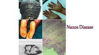 Naxos Disease
 