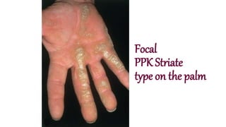 Focal
PPK Striate
type on the palm
 