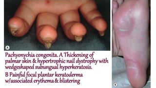 Pachyonychia congenita. A Thickening of
palmar skin & hypertrophic nail dystrophy with
wedgeshaped subungual hyperkeratosis.
B Painful focal plantar keratoderma
w/associated erythema& blistering
 