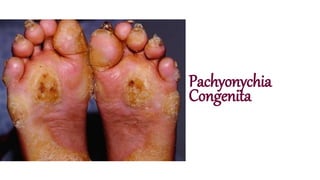 Pachyonychia
Congenita
 