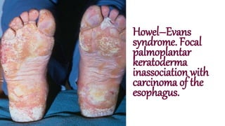 Howel–Evans
syndrome. Focal
palmoplantar
keratoderma
inassociation with
carcinoma of the
esophagus.
 