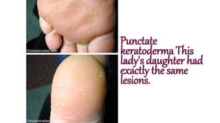 Punctate
keratoderma This
lady's daughter had
exactly the same
lesions.
 