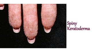 Spiny
Keratoderma
 