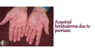 Acquired
keratoderma due to
psoriasis
 