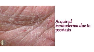 Acquired
keratoderma due to
psoriasis
 