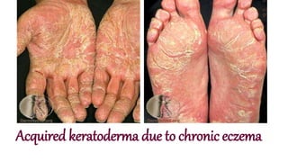 Acquired keratoderma due to chronic eczema
 