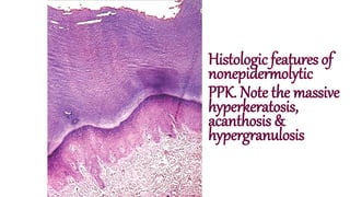 Histologic features of
nonepidermolytic
PPK. Note the massive
hyperkeratosis,
acanthosis &
hypergranulosis
 