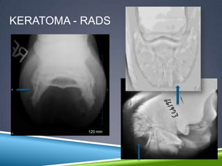 KERATOMA - RADS
 
