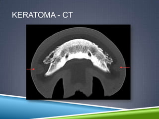 KERATOMA - CT
 