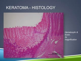 KERATOMA - HISTOLOGY




                       Hematoxylin &
                       Eosin,
                       2x
                       magnification
 