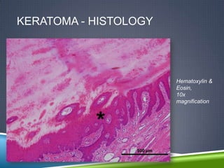 KERATOMA - HISTOLOGY




                       Hematoxylin &
                       Eosin,
                       10x
                       magnification
 