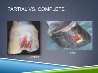 PARTIAL VS. COMPLETE




                       Partial
       Complete
 