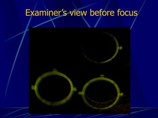 Examiner’s view before focus
 