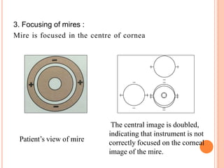 3. Focusing of mires :
Mire is focused in the centre of cornea
Patient’s view of mire
The central image is doubled,
indicating that instrument is not
correctly focused on the corneal
image of the mire.
 