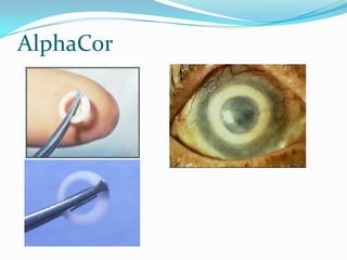 Keratoplastika | PPTX