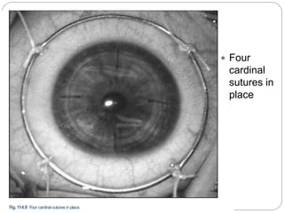  Four
cardinal
sutures in
place
 