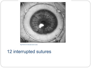 12 interrupted sutures
 