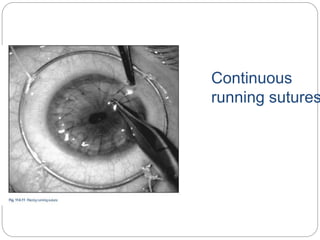Continuous
running sutures
 