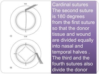 Cardinal sutures
The second suture
is 180 degrees
from the first suture
so that the donor
tissue and wound
are divided equally
into nasal and
temporal halves .
The third and the
fourth sutures also
divide the donor
 