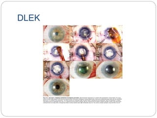 DLEK
 