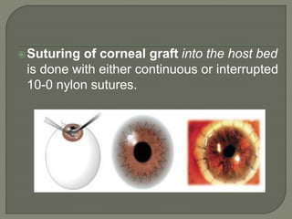 Suturing of corneal graft into the host bed
is done with either continuous or interrupted
10-0 nylon sutures.
 