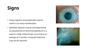 keratoplasty.corneal transplant surgery. | PPTX