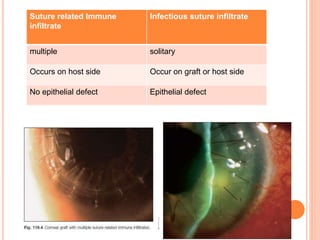 Suture related Immune
infiltrate
Infectious suture infiltrate
multiple solitary
Occurs on host side Occur on graft or host side
No epithelial defect Epithelial defect
 