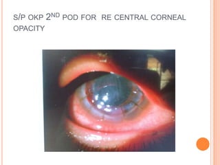 S/P OKP 2ND POD FOR RE CENTRAL CORNEAL
OPACITY
 