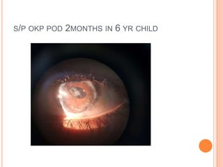 S/P OKP POD 2MONTHS IN 6 YR CHILD
 