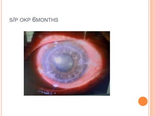 S/P OKP 6MONTHS
 