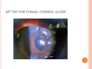 S/P TKP FOR FUNGAL CORNEAL ULCER
 