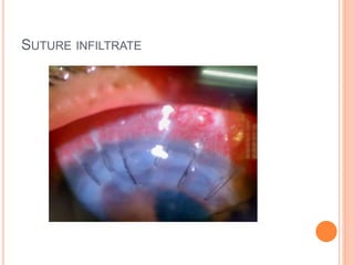 SUTURE INFILTRATE
 