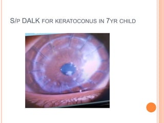S/P DALK FOR KERATOCONUS IN 7YR CHILD
 