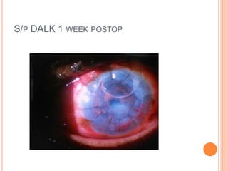 S/P DALK 1 WEEK POSTOP
 