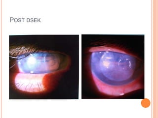 POST DSEK
 
