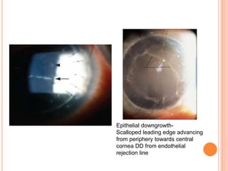 Epithelial downgrowth-
Scalloped leading edge advancing
from periphery towards central
cornea DD from endothelial
rejection line
 
