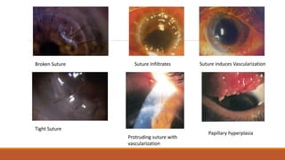 Broken Suture
Tight Suture
Suture Infiltrates Suture induces Vascularization
Protruding suture with
vascularization
Papillary hyperplasia
 