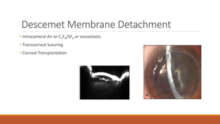 Descemet Membrane Detachment
• Intracameral Air or C3F8/SF6 or viscoelastic
• Transcorneal Suturing
• Corneal Transplantation
 
