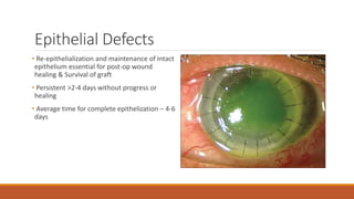 Epithelial Defects
• Re-epithelialization and maintenance of intact
epithelium essential for post-op wound
healing & Survival of graft
• Persistent >2-4 days without progress or
healing
• Average time for complete epithelization – 4-6
days
 