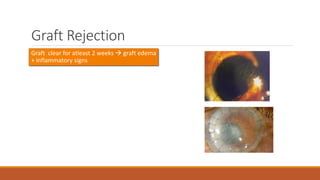 Graft Rejection
•Graft clear for atleast 2 weeks  graft edema
+ inflammatory signs
 