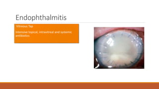 Endophthalmitis
• Vitreous Tap
•Intensive topical, intravitreal and systemic
antibiotics
 