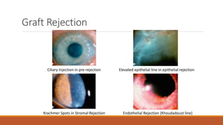 Graft Rejection
Ciliary Injection in pre-rejection Elevated epithelial line in epithelial rejection
Krachmer Spots in Stromal Rejection Endothelial Rejection (Khoudadoust line)
 